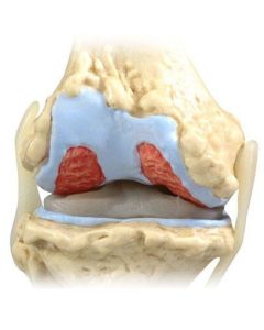 4-Stage Osteoarthritic Knee Model