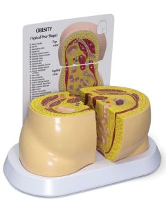 Obesity Model