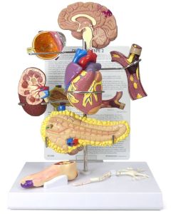 Type II Diabetes Set