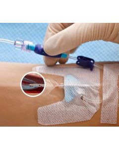 BD Nexiva™ Diffusics™ Closed IV Catheter System 20G x 1.00 in (1.1 mm x 25 mm)